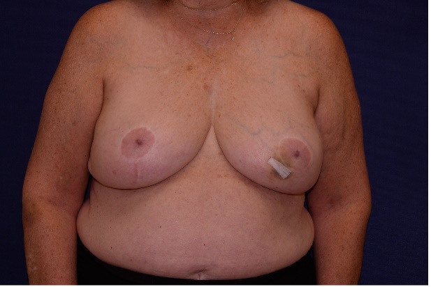 Patient with Cancer of the Left Breast