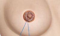 sutures placed under areola