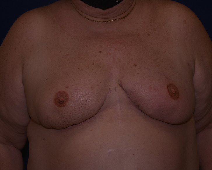 Florida Breast Reconstruction