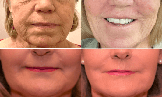 Before and After Dr. Becker’s Circum-Oral Rejuvenation