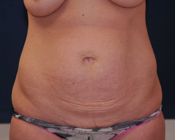 Abdominoplasty Before & After | Dr. Becker