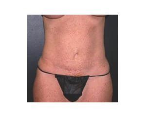 Abdominoplasty Before & After | Dr. Becker