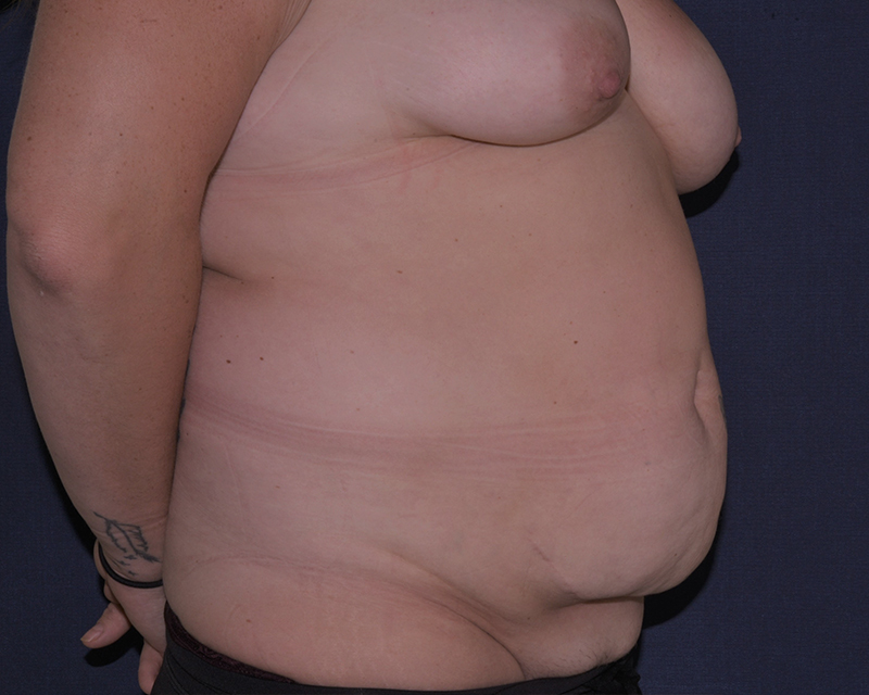 Abdominoplasty Before & After | Dr. Becker