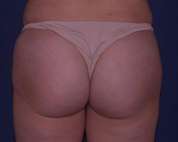 Buttock Augmentation Before & After | Dr. Becker