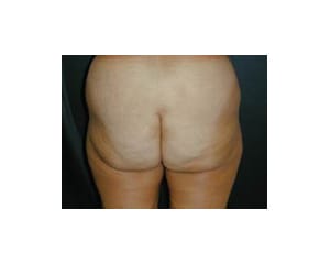 Buttock Augmentation Before & After | Dr. Becker