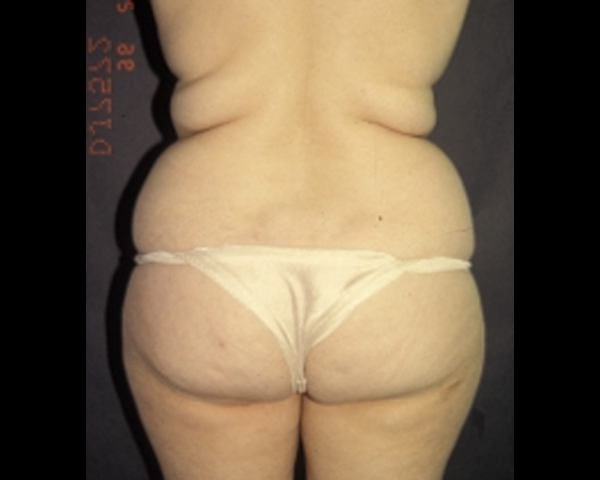 Liposuction Lipoplasty Before & After | Dr. Becker