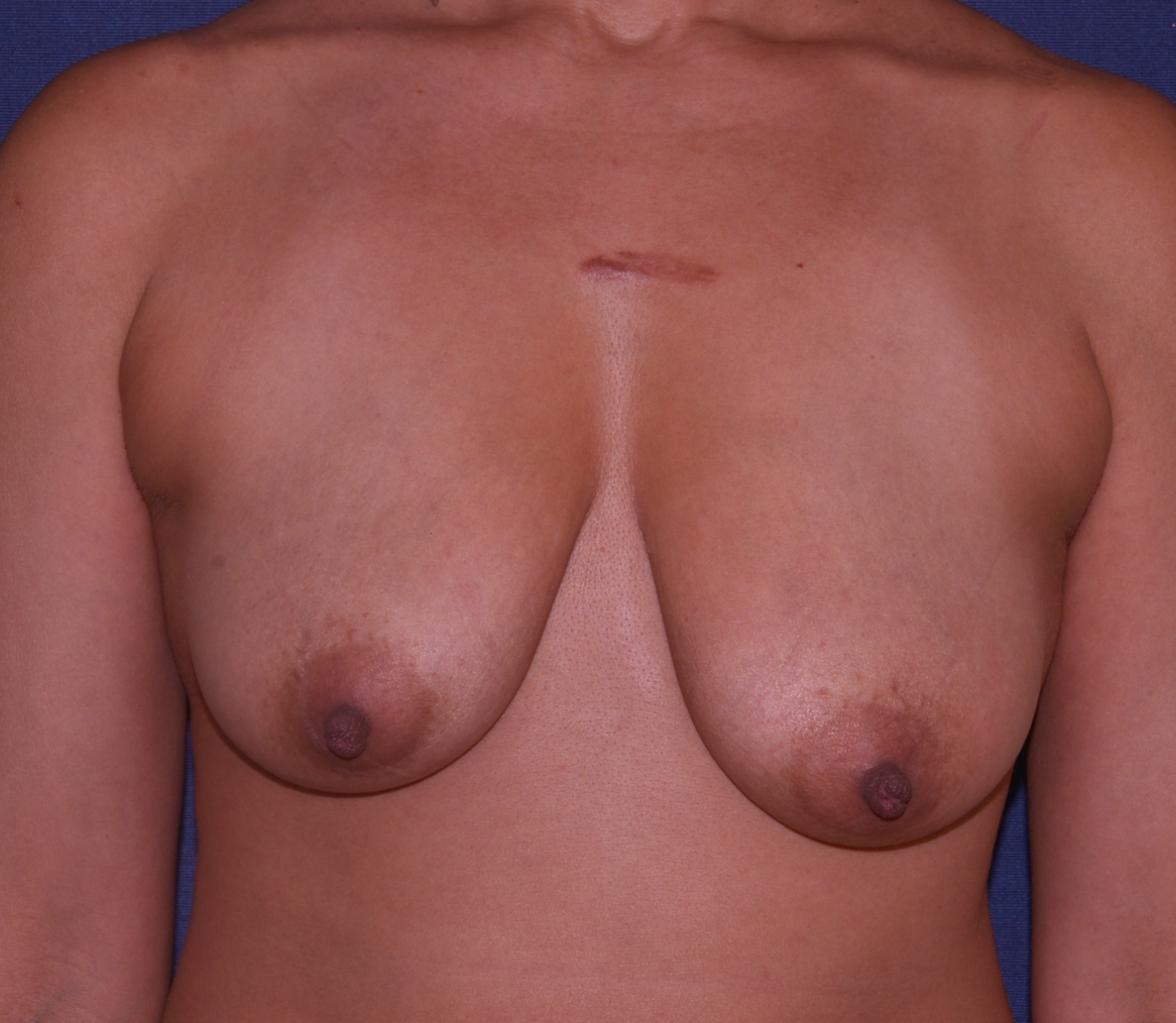 Breast Asymmetry Before & After | Dr. Becker