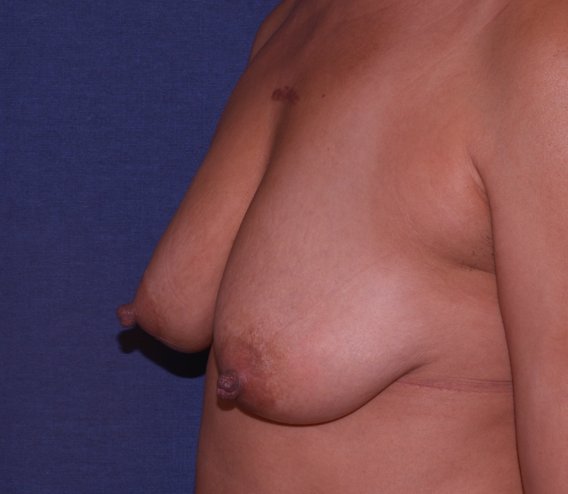 Breast Asymmetry Before & After | Dr. Becker