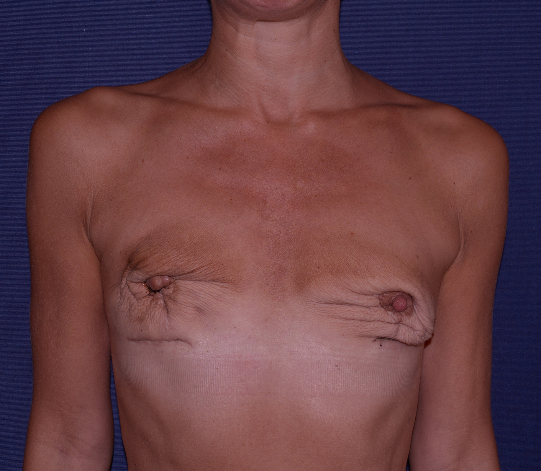 Breast Reconstruction Delayed Before & After | Dr. Becker