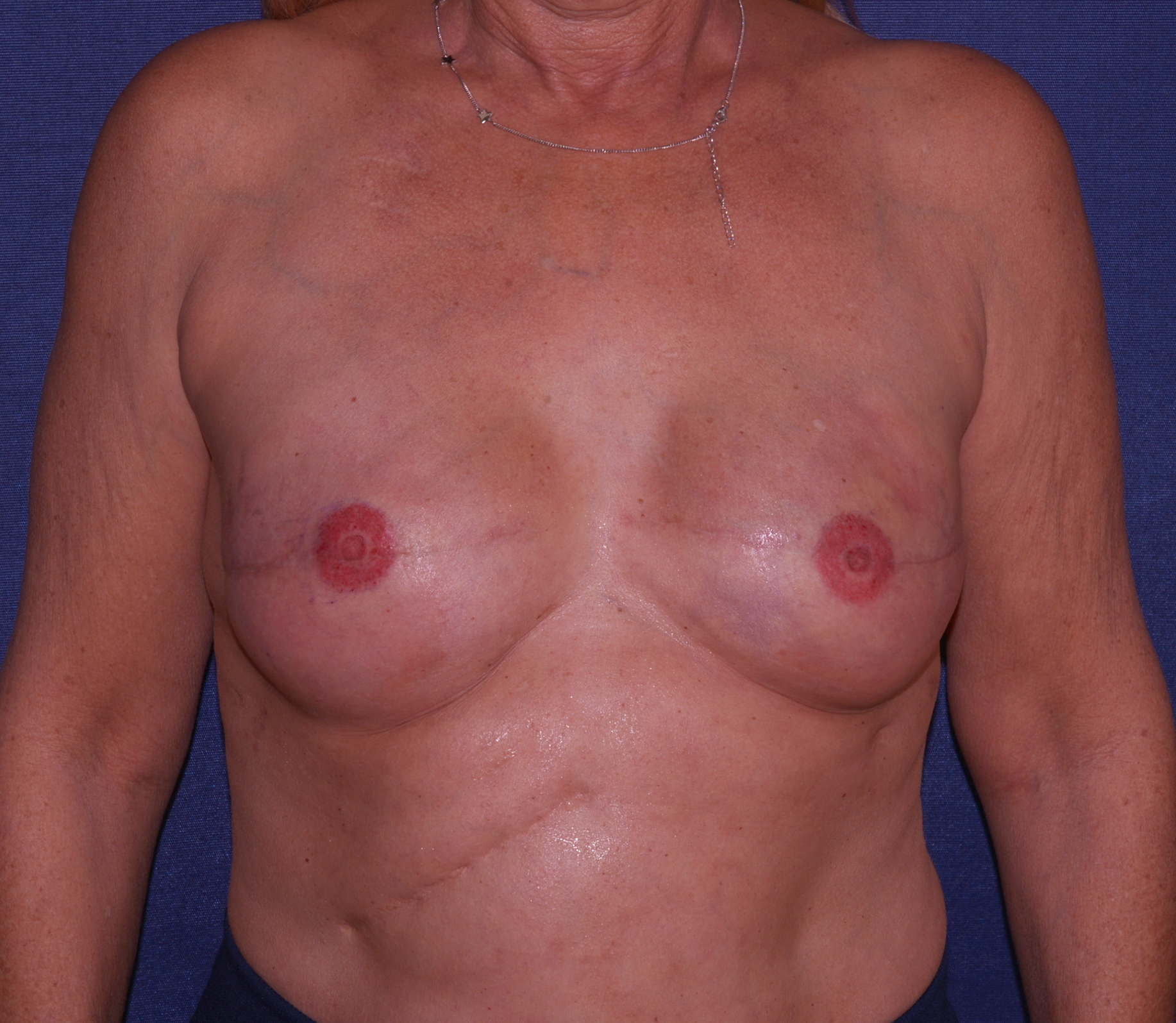 Breast Reconstruction Delayed Before & After | Dr. Becker