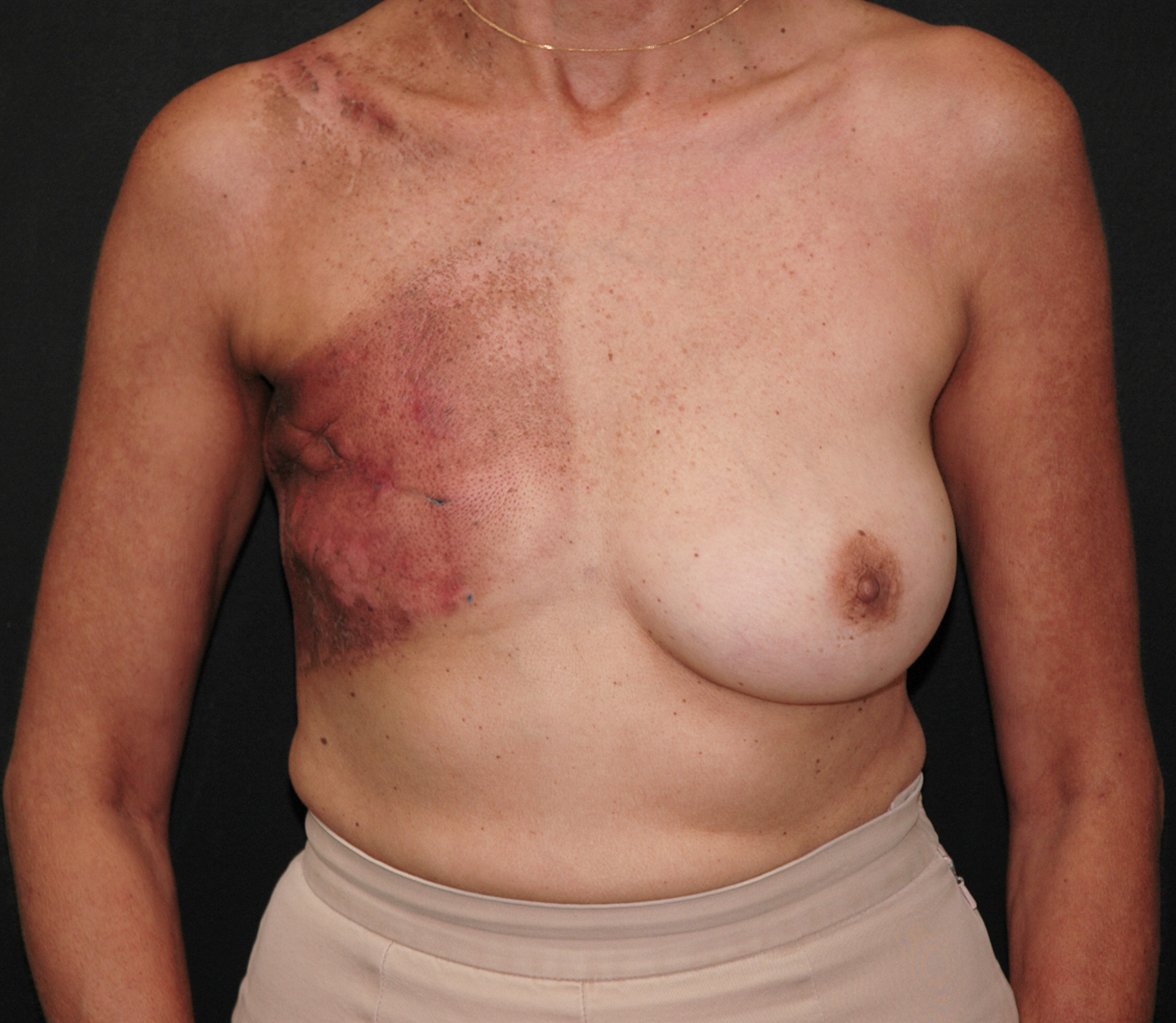 Breast Reconstruction Following Radiation Before & After | Dr. Becker