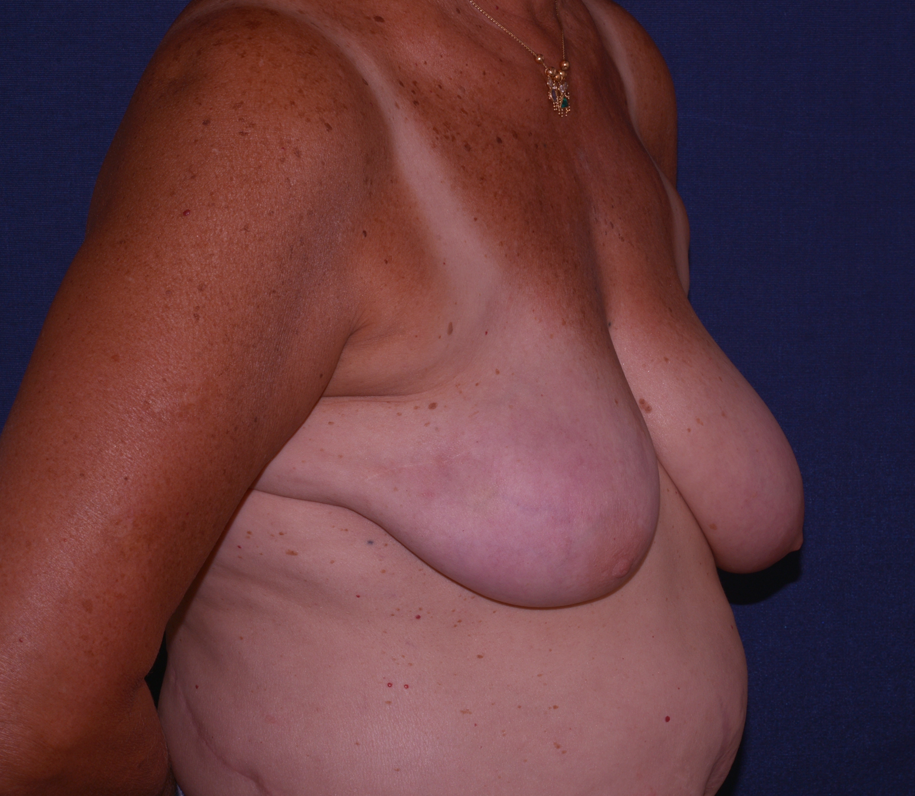 Breast Reconstruction Following Radiation Before & After | Dr. Becker