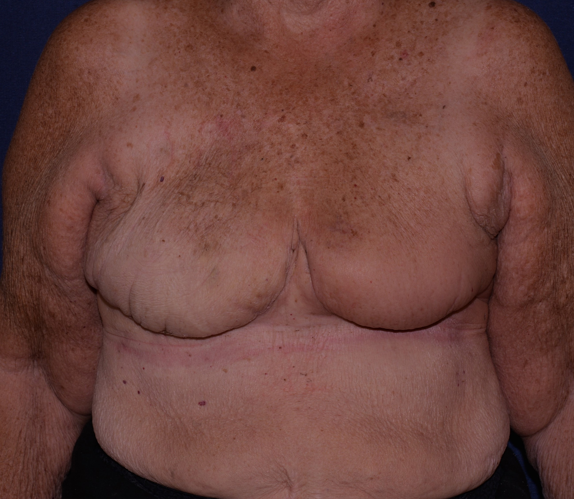 Breast Reconstruction Immediate With Local Tissue Before & After | Dr. Becker