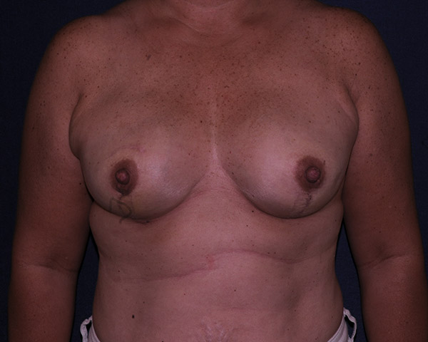 Breast Reconstruction Immediate Before & After | Dr. Becker