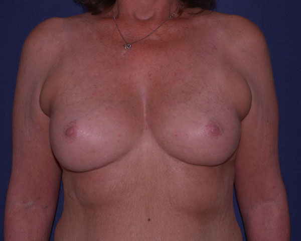 Breast Reconstruction Immediate Before & After | Dr. Becker
