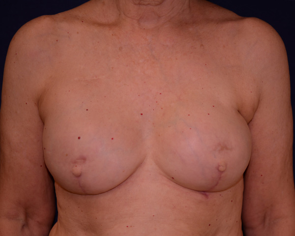 Breast Reconstruction Revision Before & After | Dr. Becker