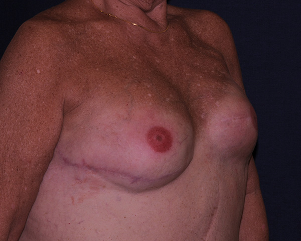 Breast Reconstruction Revision Before & After | Dr. Becker