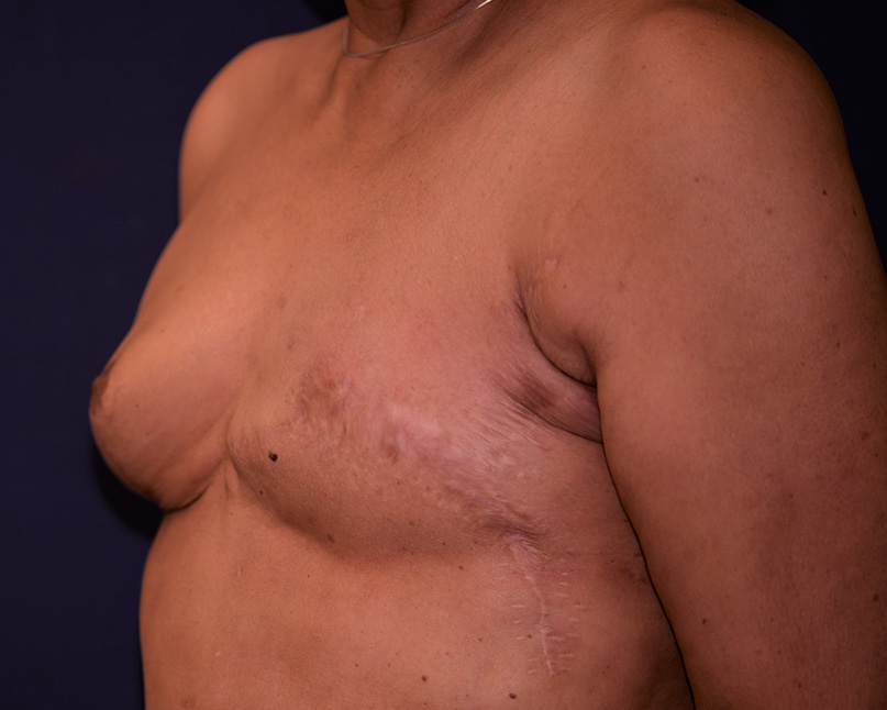 Breast Reconstruction With Fat Grafting Before & After | Dr. Becker