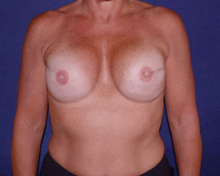 Breast Reconstruction With Fat Grafting Before & After | Dr. Becker