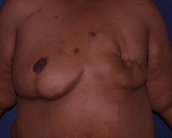 Breast Reconstruction With Fat Grafting Before & After | Dr. Becker