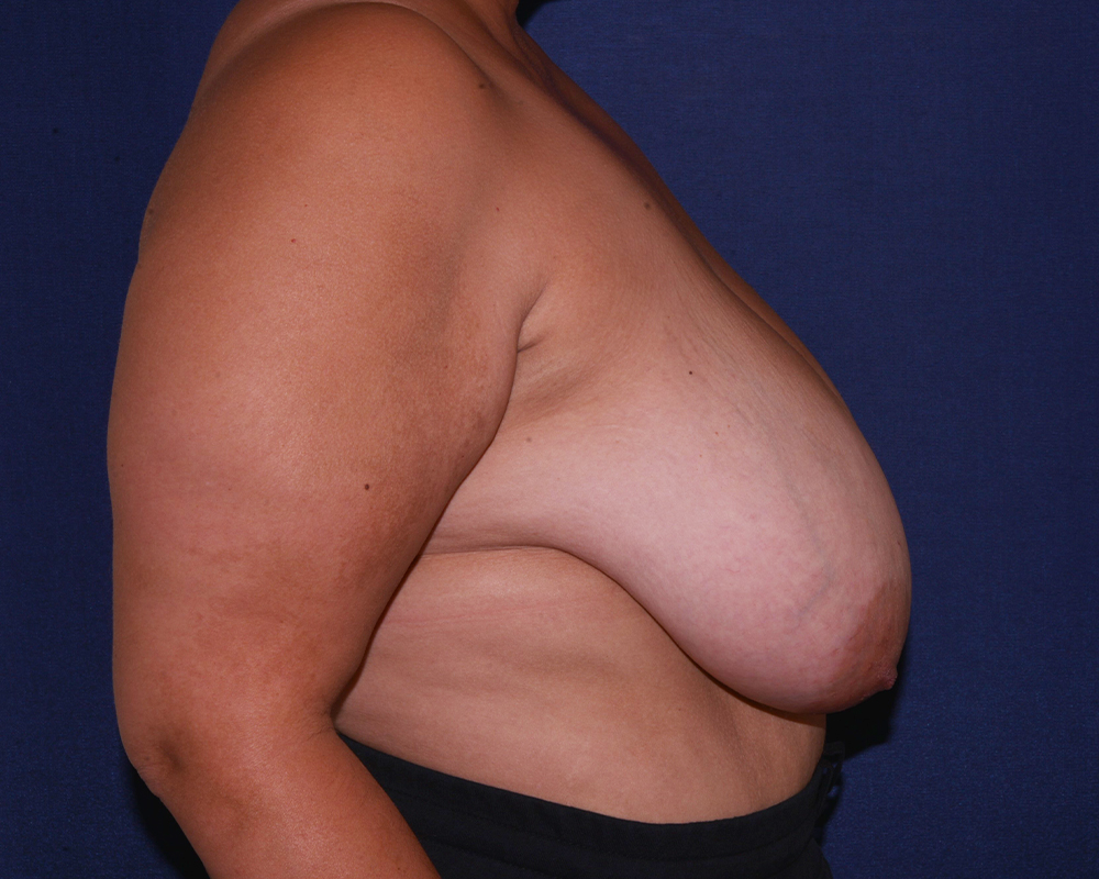 Breast Reconstruction Before & After | Dr. Becker
