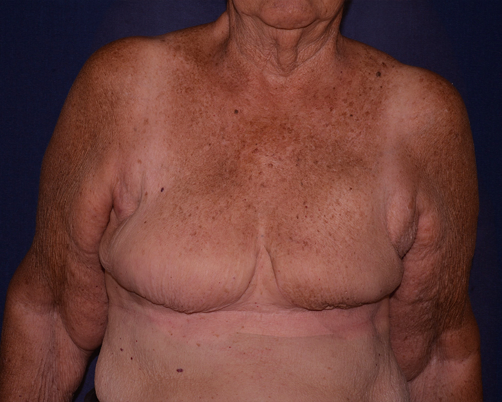 Breast Reconstruction Before & After | Dr. Becker