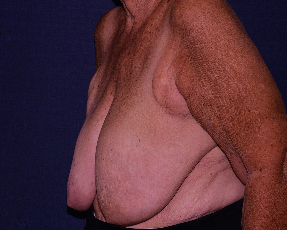 Breast Reconstruction Before & After | Dr. Becker