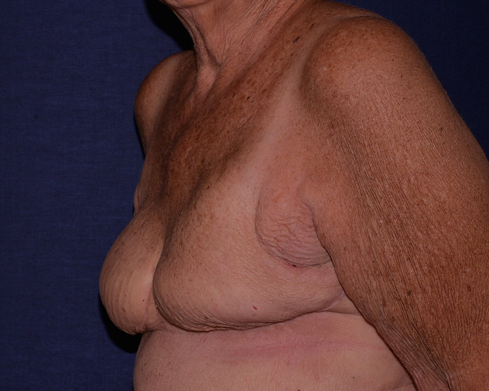 Breast Reconstruction Before & After | Dr. Becker