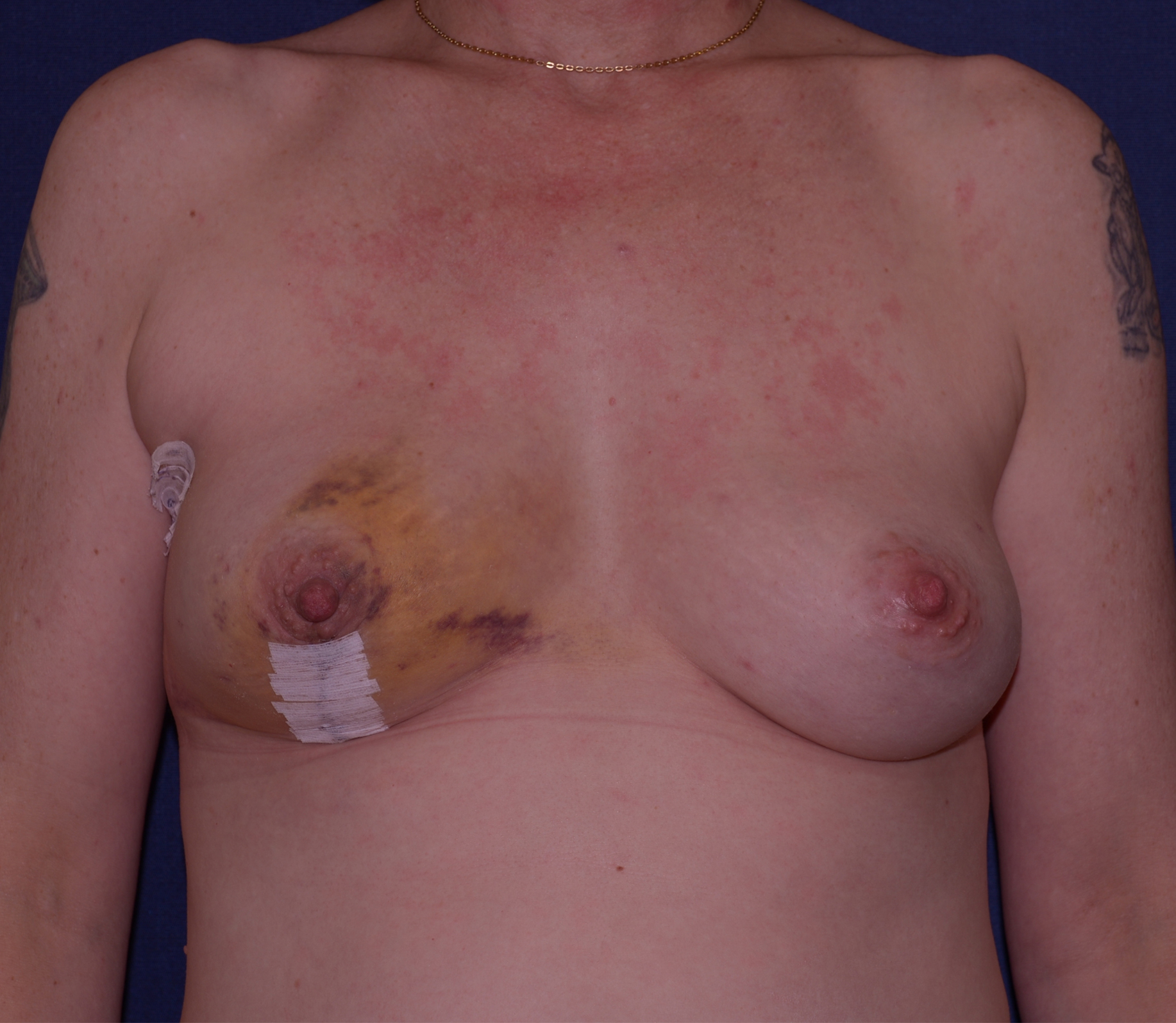 Breast Reconstruction Before & After | Dr. Becker