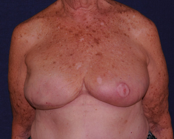 Breast Reconstruction Before & After | Dr. Becker