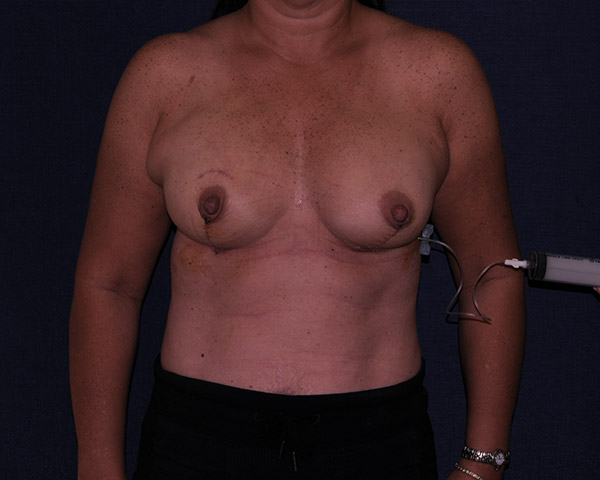 Breast Reconstruction Before & After | Dr. Becker