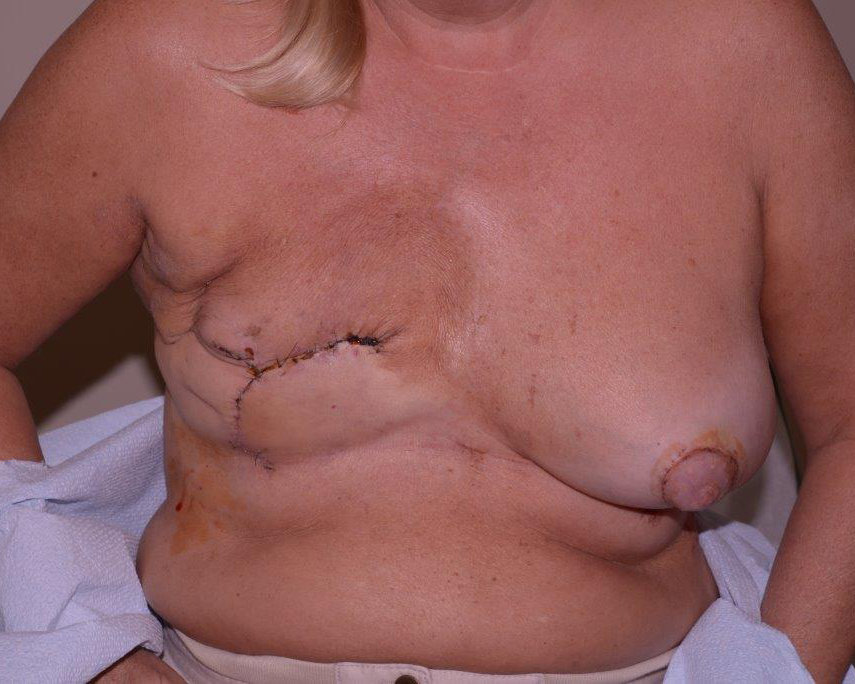 Breast Reconstruction Before & After | Dr. Becker