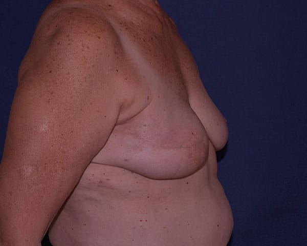 Breast Reconstruction Before & After | Dr. Becker