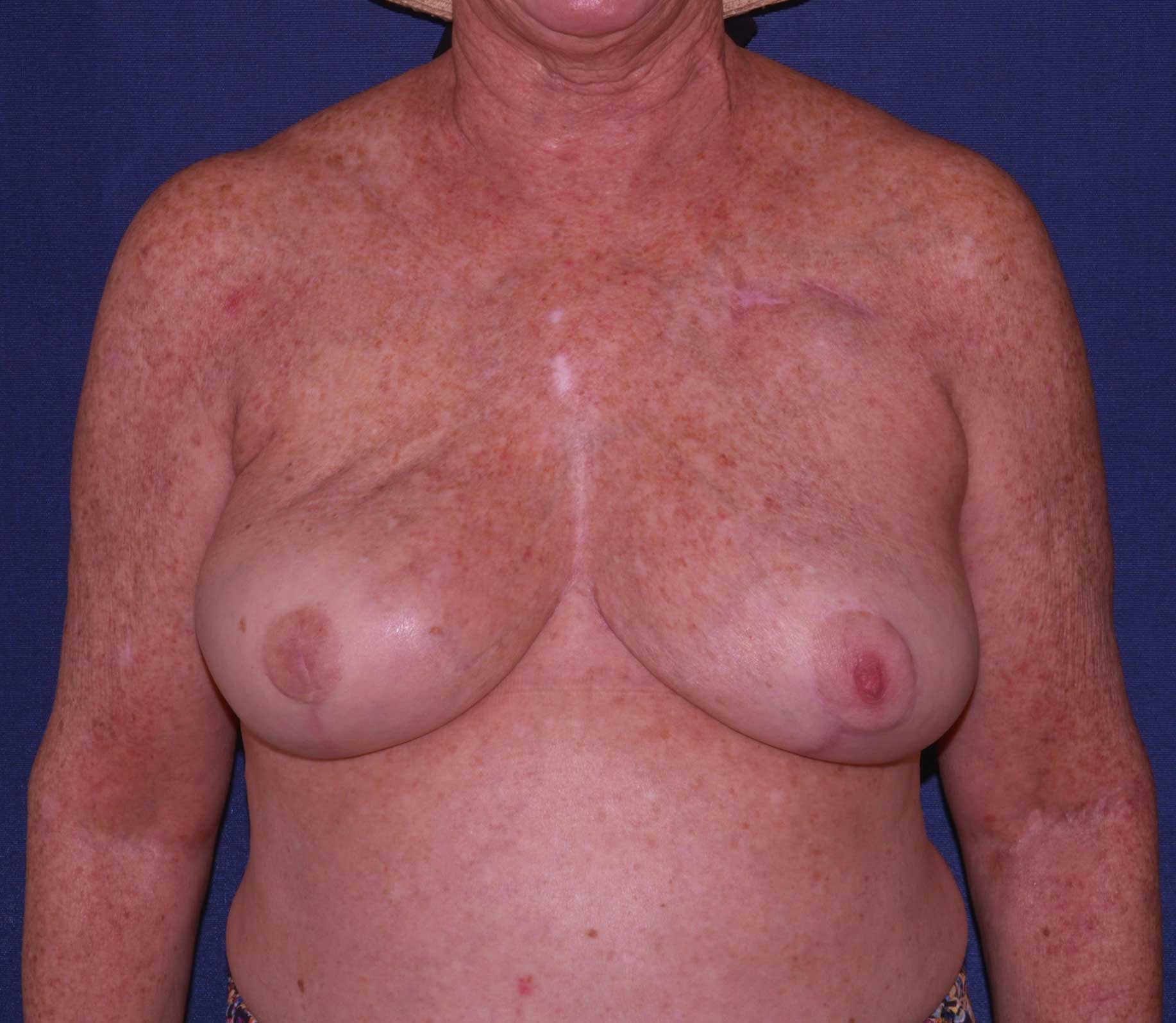 Breast Reconstruction Before & After | Dr. Becker