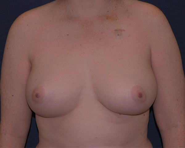 Breast Reconstruction Before & After | Dr. Becker