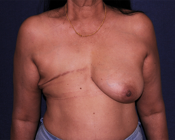 Breast Reconstruction Before & After | Dr. Becker