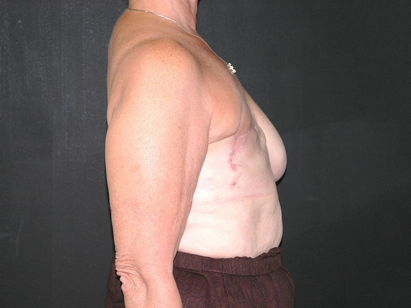 Breast Reconstruction Before & After | Dr. Becker
