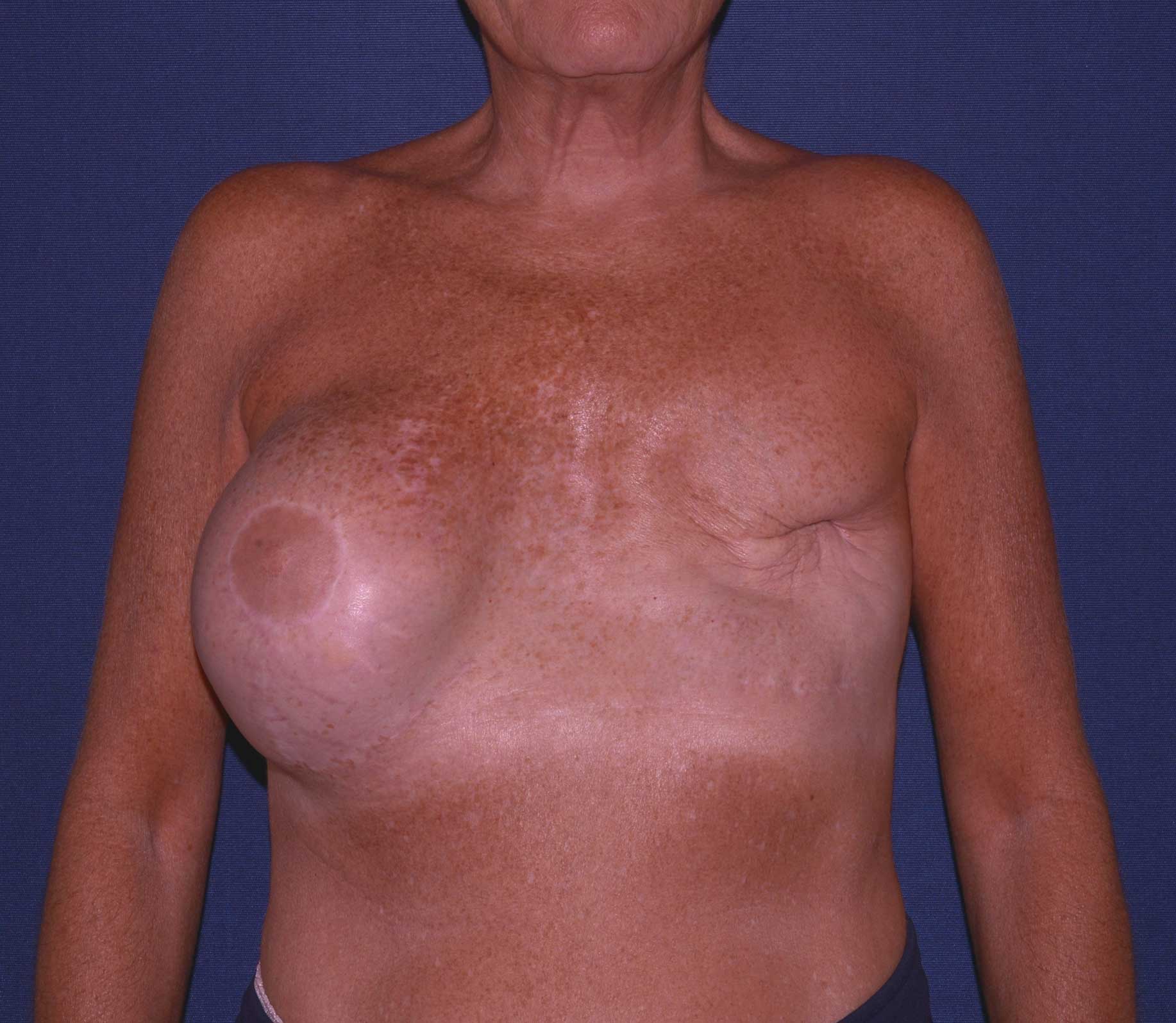 Breast Reconstruction Before & After | Dr. Becker
