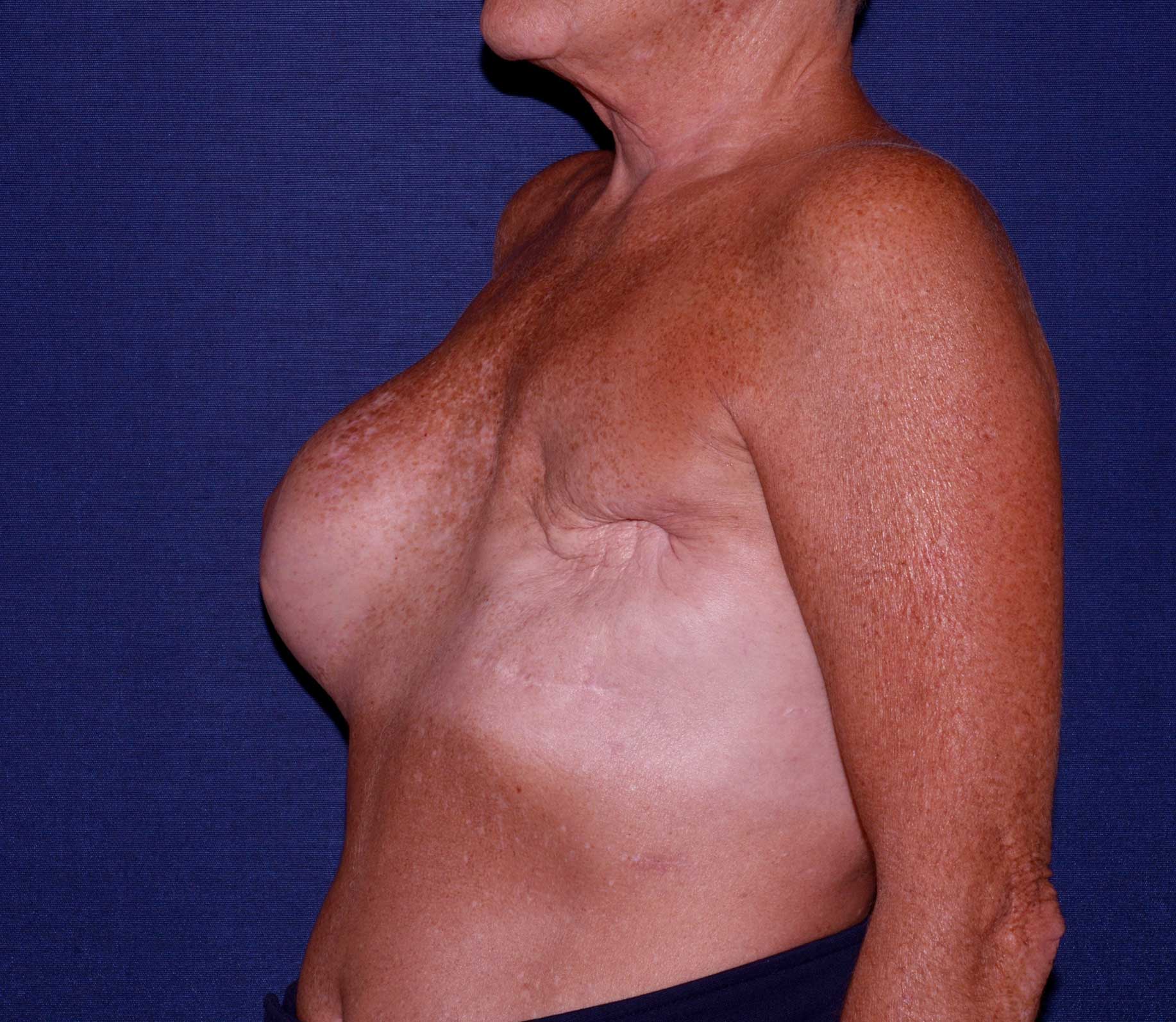 Breast Reconstruction Before & After | Dr. Becker