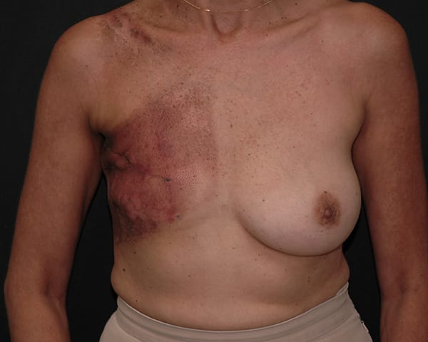 Breast Reconstruction Before & After | Dr. Becker