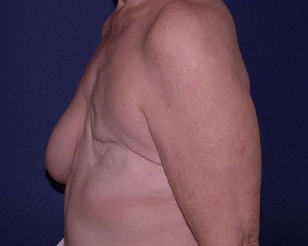 Breast Reconstruction Before & After | Dr. Becker