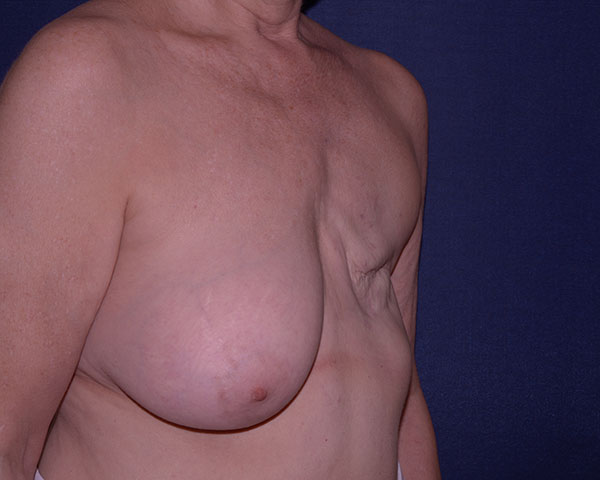 Breast Reconstruction Before & After | Dr. Becker