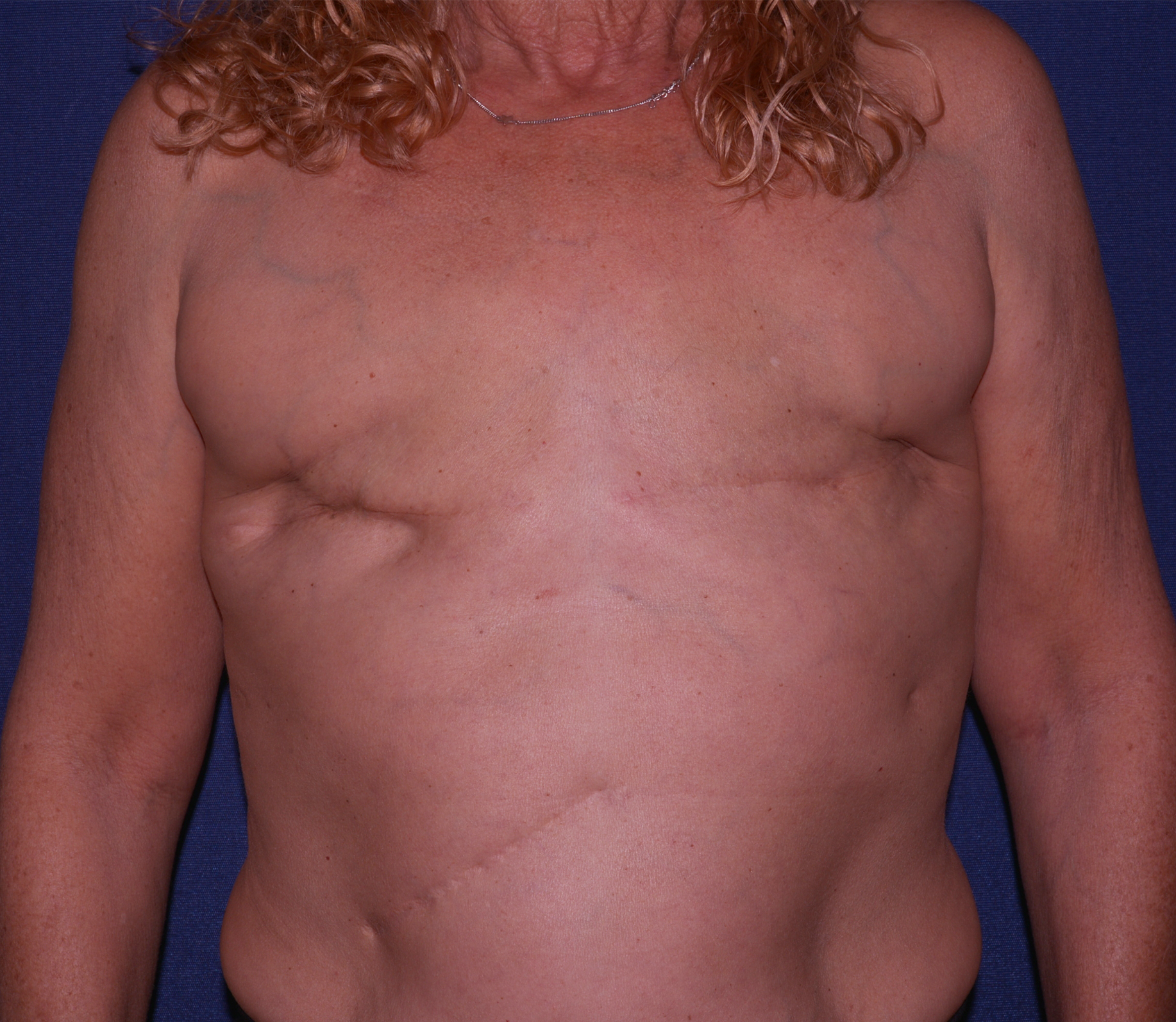 Breast Reconstruction Before & After | Dr. Becker