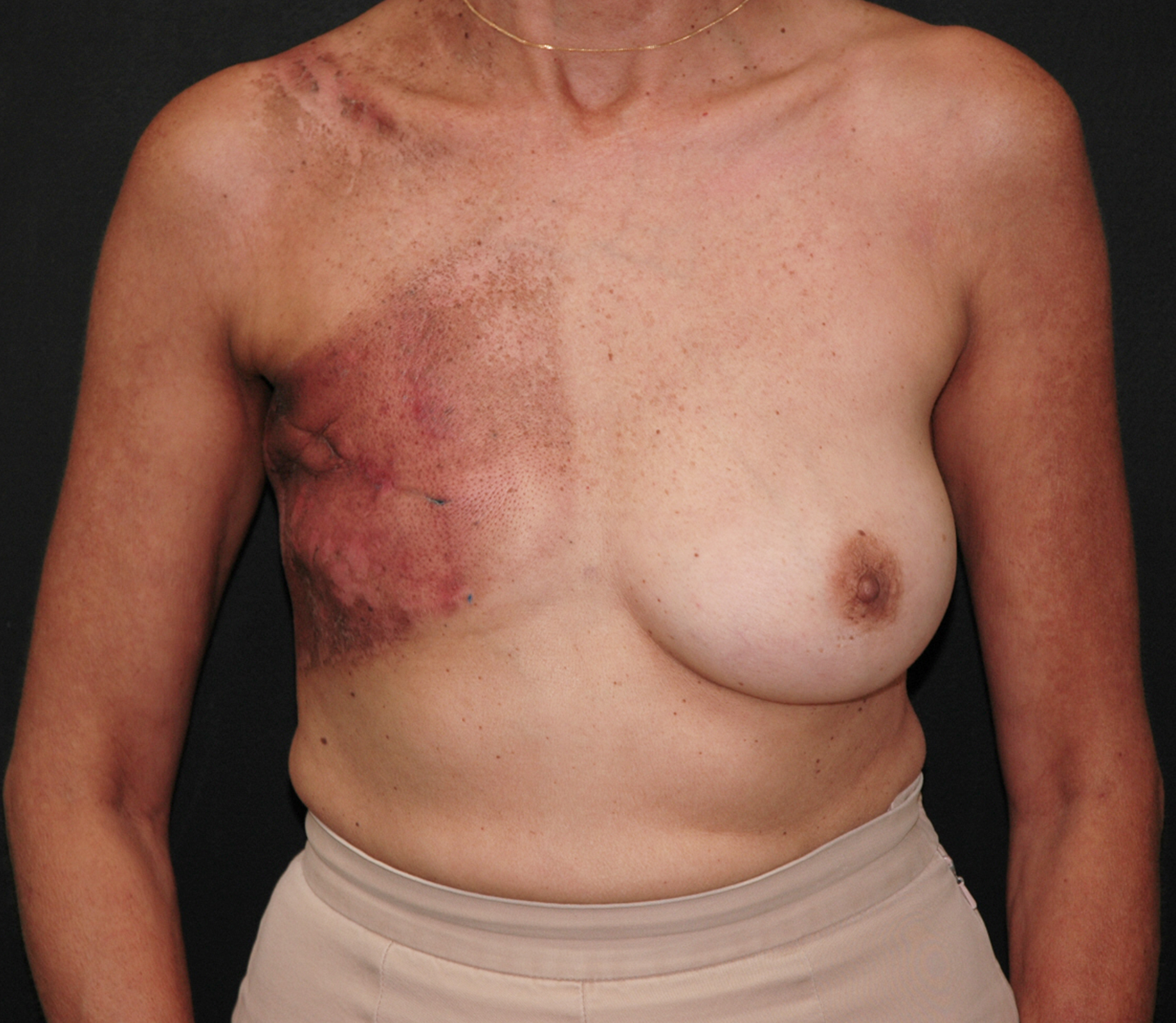 Breast Reconstruction Before & After | Dr. Becker