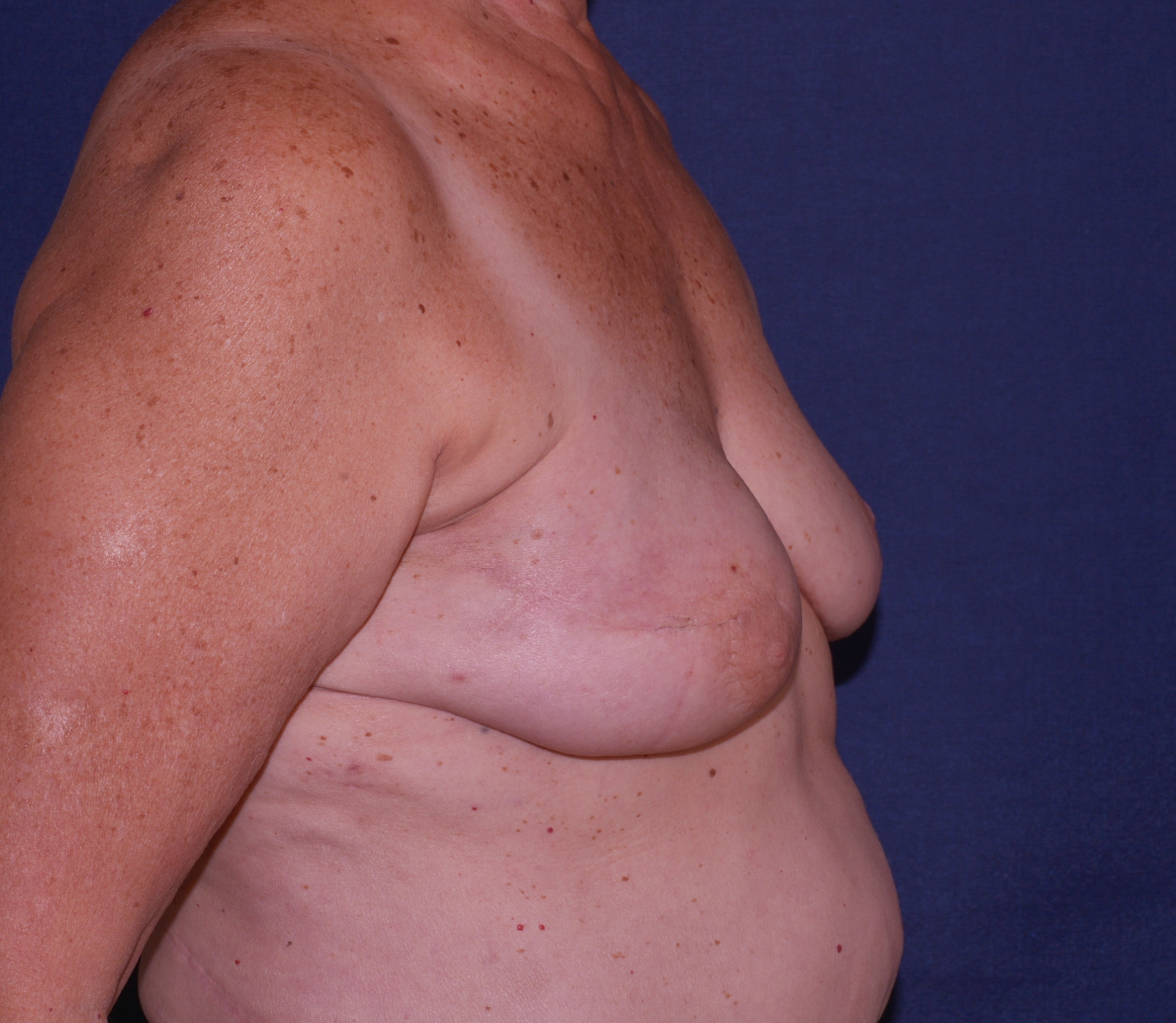 Breast Reconstruction Before & After | Dr. Becker