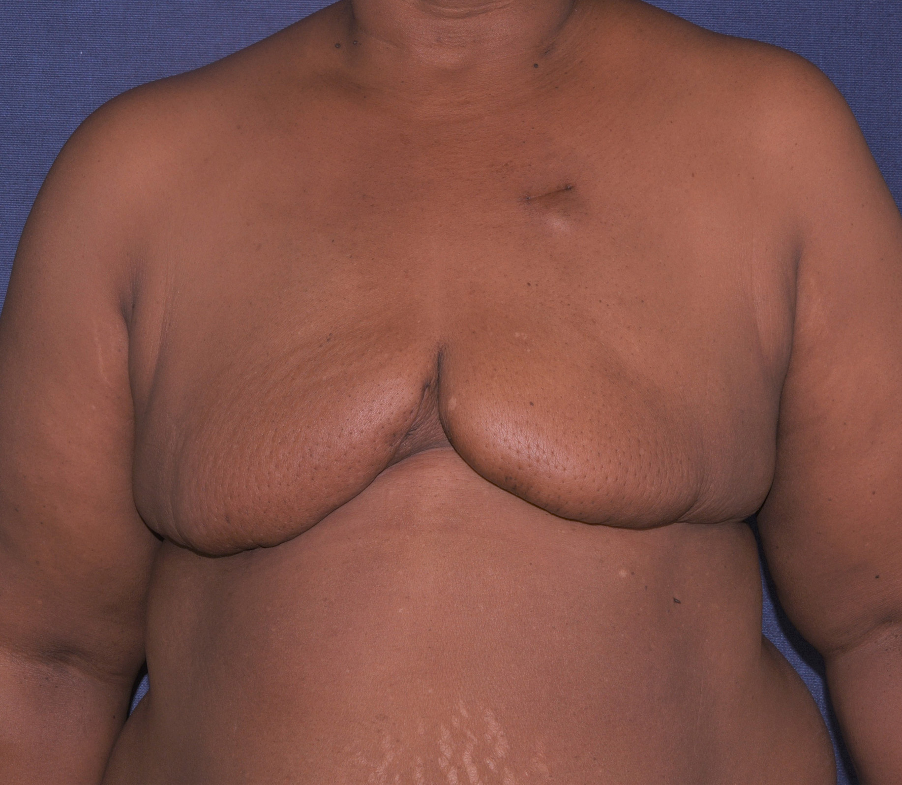 Breast Reconstruction Before & After | Dr. Becker