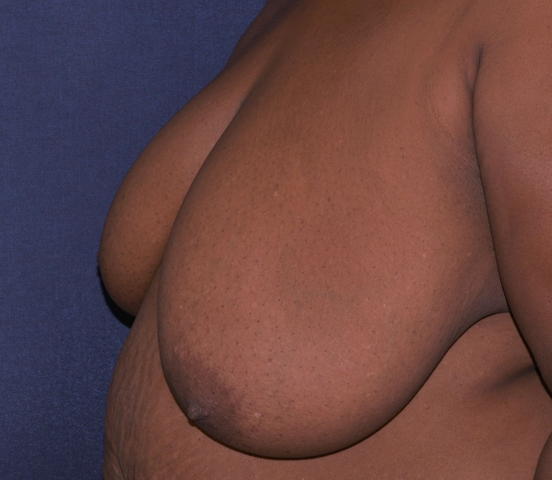 Breast Reconstruction Before & After | Dr. Becker