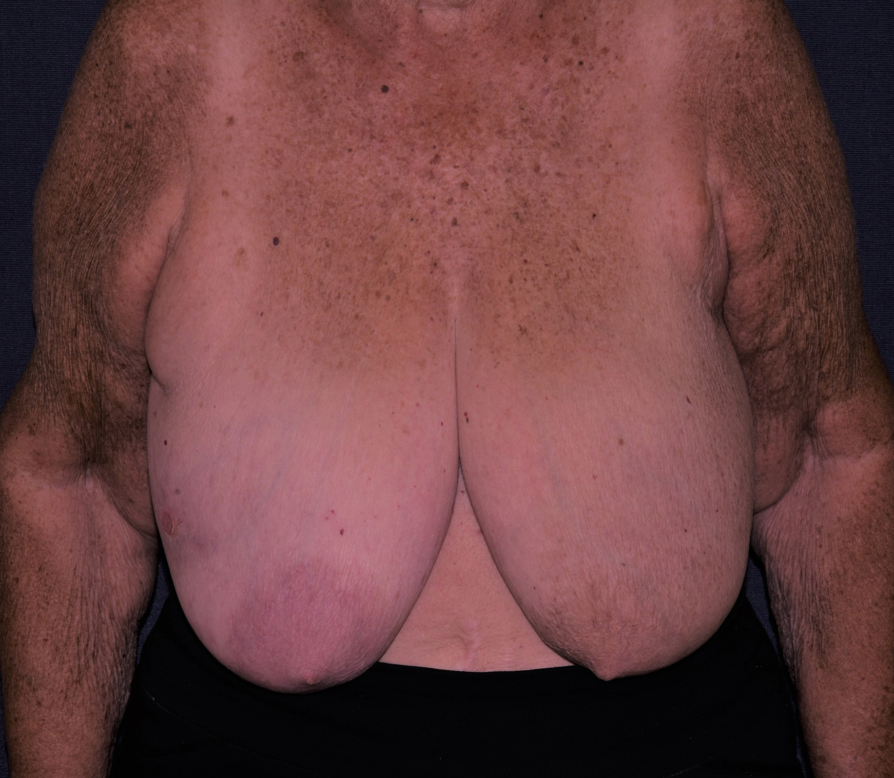 Breast Reconstruction Before & After | Dr. Becker