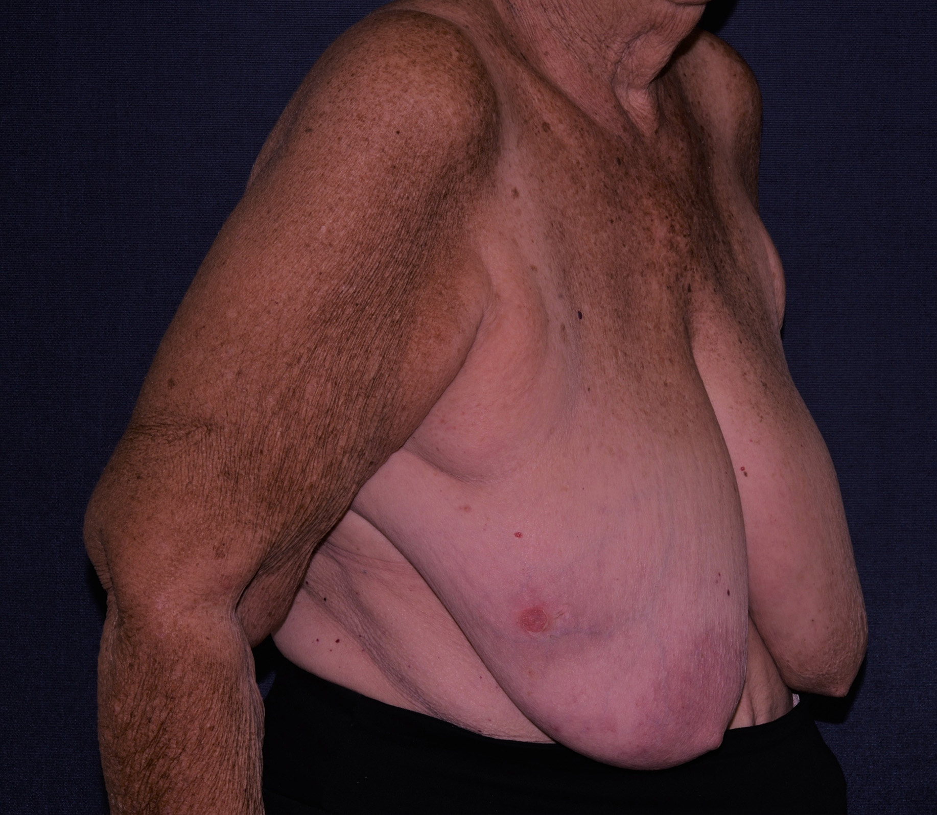 Breast Reconstruction Before & After | Dr. Becker