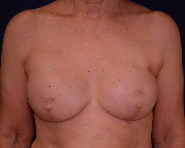 Breast Reconstruction Before & After | Dr. Becker